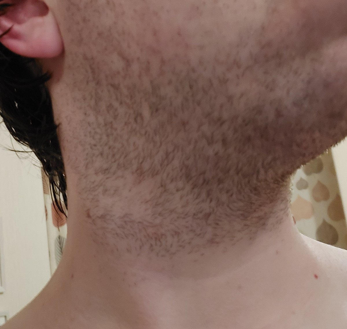 Millie CD/TS/Sissy в Twitter: „The first pic shows my facial hair growth  after 2 days before any IPL treatment, the second shows 2 days of growth  after 3 IPL sessions, what a