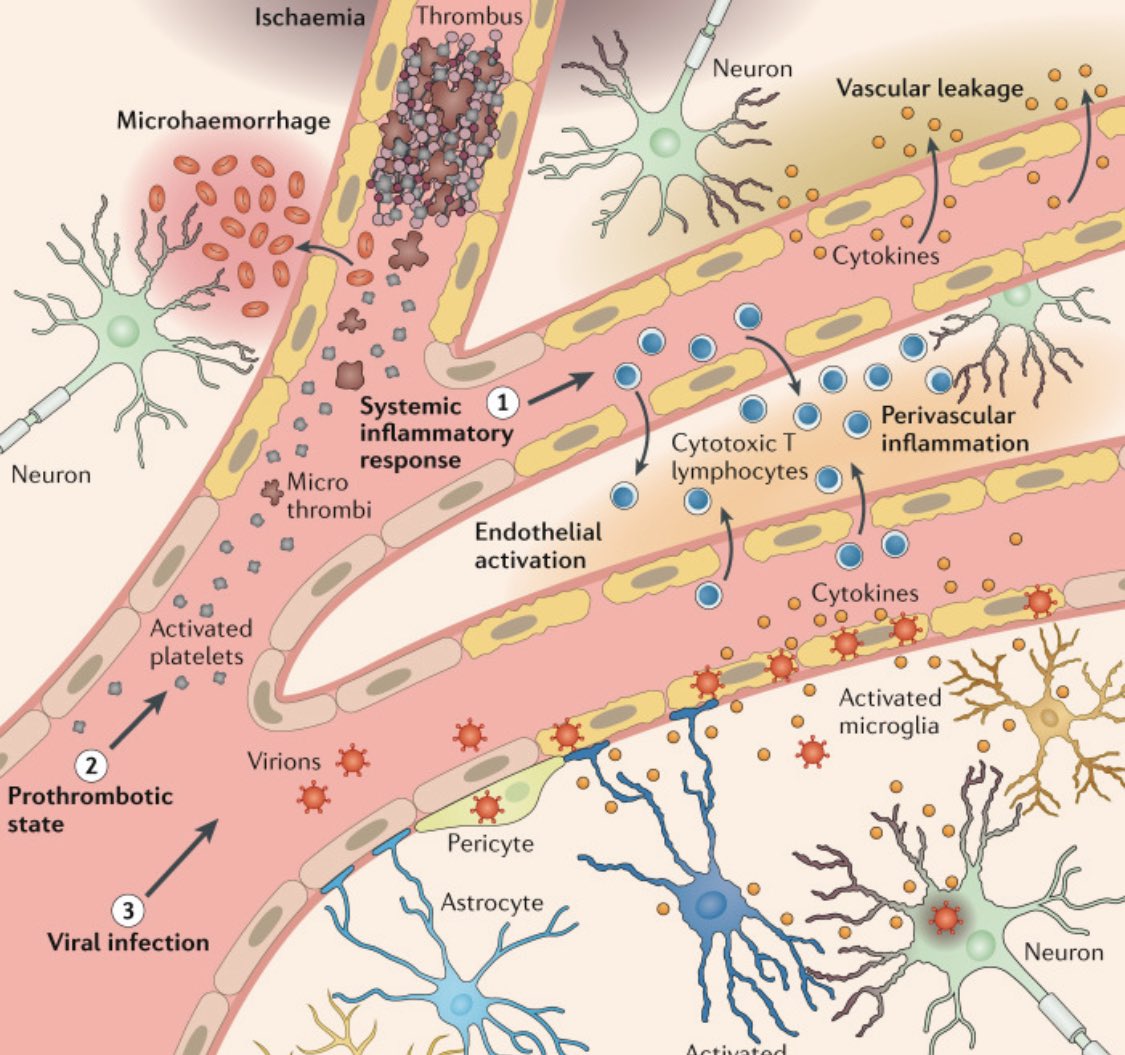 LongCOVIDPhysio's tweet photo. “Neurological infection with SARS-CoV-2 - the story so far”
@RunningMadProf 
https://t.co/0vSFQqUNlf https://t.co/eolTUCW1FK