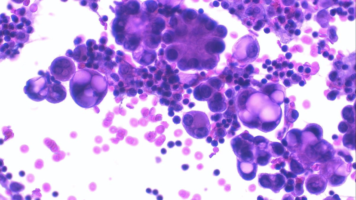 JCandidoXavier's tweet photo. POSITIVE ASCITC FLUID CYTOLOGY
Mucinous ovarian carcinoma

#cytology #citología #citologia #cytopathology #cytopath #path #gypath #PathTwitter https://t.co/dLGnQU08ac