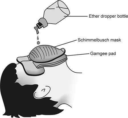 AnesPsmchs's tweet photo. 🔴 Open drop anesthesia: It is not used in modern anesthesia. 
A technique for producing inhalation anesthesia in which drops of a liquid anesthetic, such as ether, are placed on a gauze mask or cone applied over the mouth and nose. https://t.co/Hqvw7hALBy