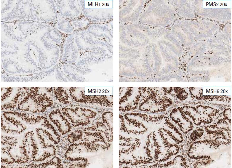 RocheDiaUSA's tweet photo. You are reviewing the VENTANA MMR RxDx Panel stained IHC endometrial carcinoma case.
Do you see signals in the internal control cells showing appropriate staining?
A.Yes
https://t.co/TQdXblzUFG
C.I don’t know
#tweetorialtuesday #IHCPath #RocheMSA #endometrialcarcinoma https://t.co/nZIUuzF6qj