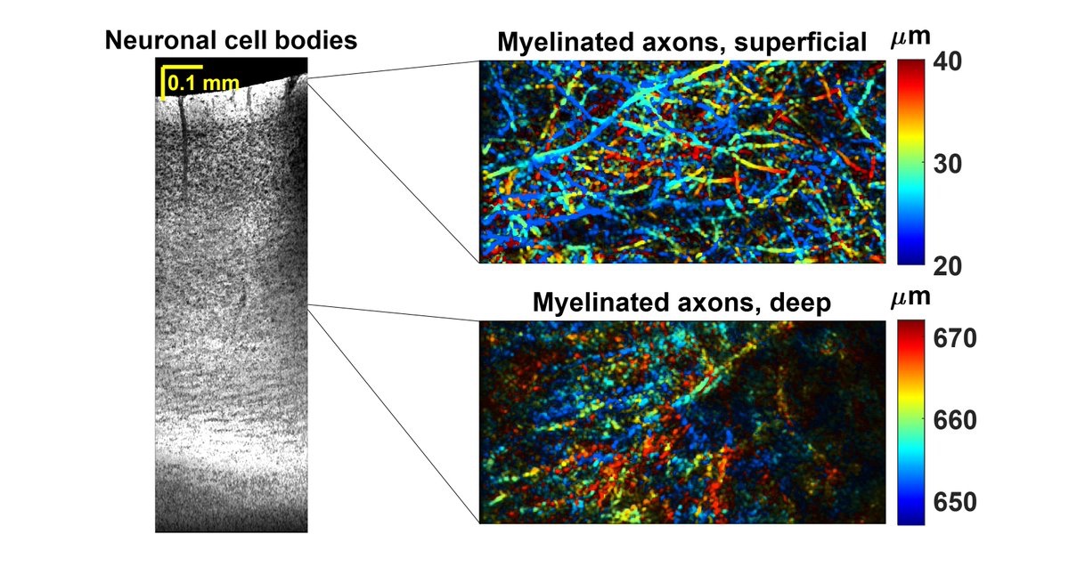 vjsriniv's tweet photo. Congrats to @JunZhu_light on her recent 1700 nm Optical Coherence Microscopy work in @LightSciAppl: minimally invasive, high-res, and deep #brain imaging... all rolled into one! @nyugrossman @UCDavisBME @UCDavisCOE 

Read here: https://t.co/nowRFlDGIa https://t.co/MKdqeUZL3a