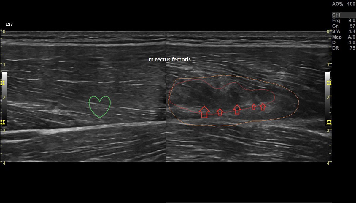 SportklinikBern's tweet photo. #muscleinjury of the #rectusfemoris in #mskus and #mri comparison - I think the ultrasound view is equivalent or even better -#mpocus #pocushub #s7r3 #sportsinjury https://t.co/XRpjdh81Wg