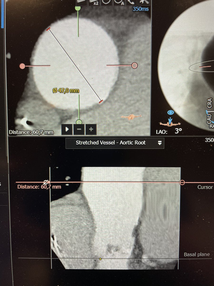 Low risk 81 yr old🧑‍🦳, good general condition, symptomatic tricuspid severe AS (no AR). Good vascular access. Annulus suitable for S3 23 but ascending aorta dilation (47mm). TAVR or SAVR + ascending aortoplasty ? #tavr <a href="/GilbertTangMD/">Dr. Gilbert Tang</a> <a href="/PPibarot/">Philippe Pibarot</a> <a href="/hahn_rt/">RTHahnMD</a> <a href="/djc795/">David J. Cohen, MD, MSc</a> <a href="/igeorge1975/">Isaac George MD</a>