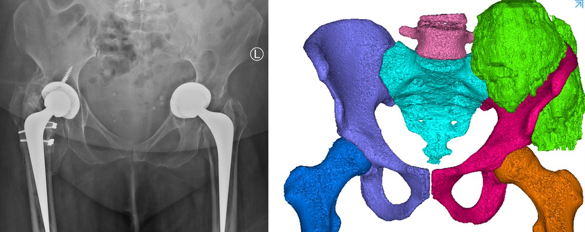 The blog article below discusses how MARS photon-counting CT imaging could enable even better patient-specific implants to be created for complex cases, such as bone cancer. 

marsbioimaging.com/2021/05/26/bui…

Sign up here to learn more about MARS: marsbioimaging.activehosted.com/f/1