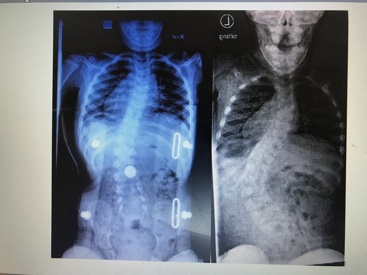 BulowOPS's tweet photo. Did you know we have a pediatric scoliosis specialist on staff? This patient initially presented with a 63-degree Thoracolumbar curve and the in-brace x-ray results showed his curve was corrected to 25 degrees while in his Custom Scoliosis Orthosis that Kaitlynn Wilson, CPO fabr https://t.co/8v8exkvRY3