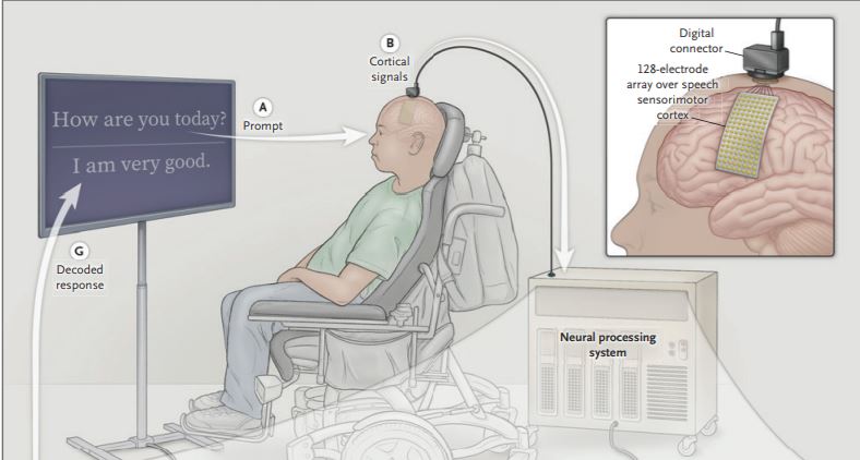 BREAKING! Researchers at <a href="/UCSF/">UC San Francisco</a> showed full words and sentences being decoded from brain activity. Data were collected across 128 electrodes placed over the speech areas of the brain. 50 words could be detected consistently, allowing for 1,000 sentences.
npr.org/sections/healt…
