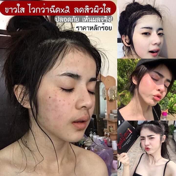 Nameskin1's tweet image. ไซโกโนะมาแล้วจ้า เปลี่ยนผิวพังใน1กล่องเท่านั้น ราคา270บาทรวมส่งเลยจ้าของแท้แน่นอนทักมาขอรีวิวได้นะคะ ลดสิว ผิวใสแน่นอน รีวิวเเน่น ทักมาปรึกษาได้น้า #ไซโกโนะ #ผิวขาวใส #สิวหาย #คอลลาเจน #ผิวขาว #สวย #ผิวกระจ่าง🌷❤️