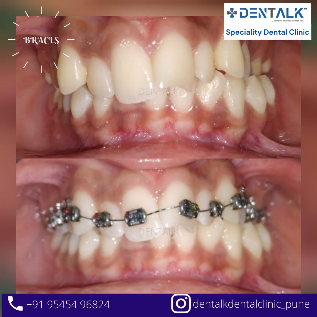 ClinicDentalk's tweet photo. #braces #dentistry #dentists https://t.co/xLLcEuMP7E