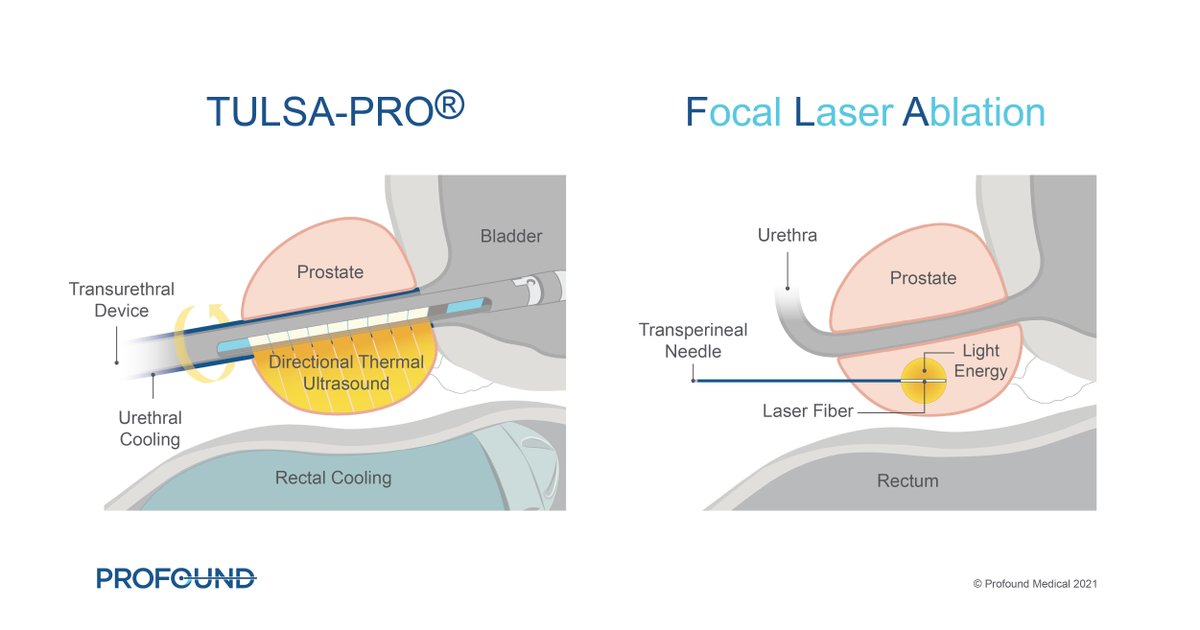ProfoundMedical's tweet photo. #tulsapro uses directional ultrasound to ablate prostate tissue and FLA uses high-energy light. To learn more about these differences, read our blog here: https://t.co/ScM4T380aW

#profound #urology #radiology #prostatecancer #ablatetheprostate #menshealth #tulsaprocedure https://t.co/nWKdG99HUB