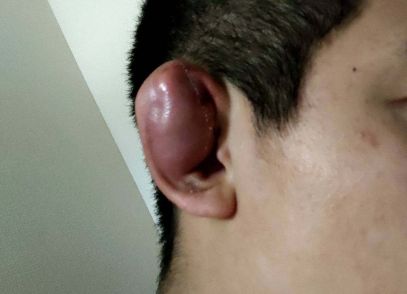 K遜 息子の耳が爆弾 破裂するかもしれないから練習中はテーピングぐるぐる巻いてるらしい 盆に帰省した時に固めるしかないな 柔道耳 T Co Vpuytsyntb Twitter