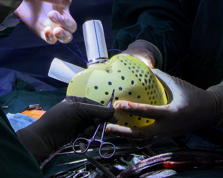 A <a href="/DukeHospital/">Duke University Hospital</a> team successfully implanted a new-generation artificial heart in a 39 year old Shalotte, North Carolina man. The patient experienced heart failure. This is the 1st procedure with the device in North America.

<a href="/DukeHeart/">DukeHeart</a> | #HeartTransplant

bddy.me/36AboeT