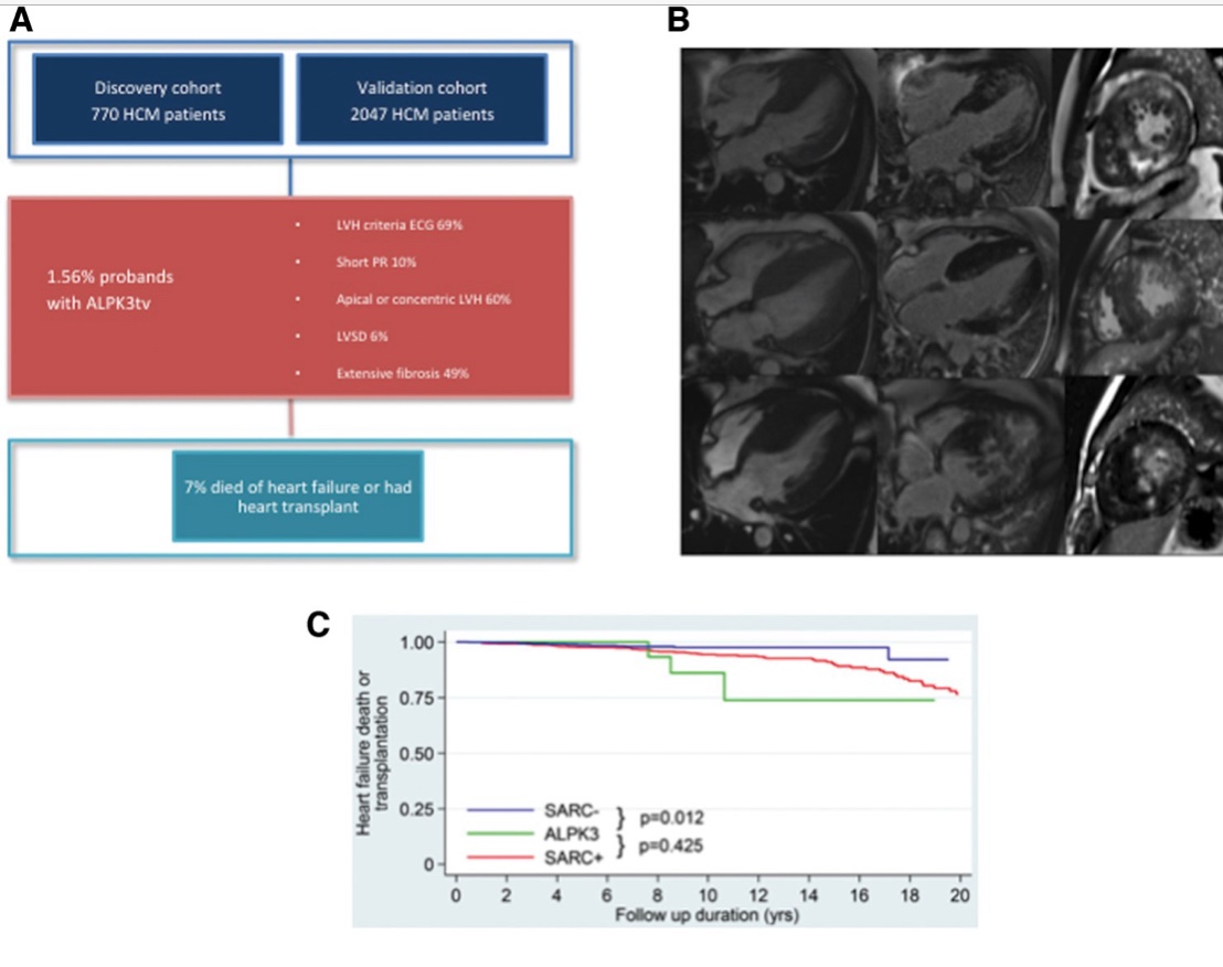 Luis Lopes (@luisrlopes77) on Twitter photo Just out our paper <a href="/ESC_Journals/">European Society of Cardiology Journals</a> ALPK3-truncating variants are a cause of autosomal dominant hypertrophic cardiomyopathy academic.oup.com/eurheartj/adva… - great international collaboration, one more #HCM causal gene and contribution to the sarcomere-negative cohort <a href="/UCL_ICS/">UCL Institute of Cardiovascular Science</a> <a href="/The_MRC/">Medical Research Council</a> Just out our paper <a href="/ESC_Journals/">European Society of Cardiology Journals</a> ALPK3-truncating variants are a cause of autosomal dominant hypertrophic cardiomyopathy academic.oup.com/eurheartj/adva… - great international collaboration, one more #HCM causal gene and contribution to the sarcomere-negative cohort <a href="/UCL_ICS/">UCL Institute of Cardiovascular Science</a> <a href="/The_MRC/">Medical Research Council</a>