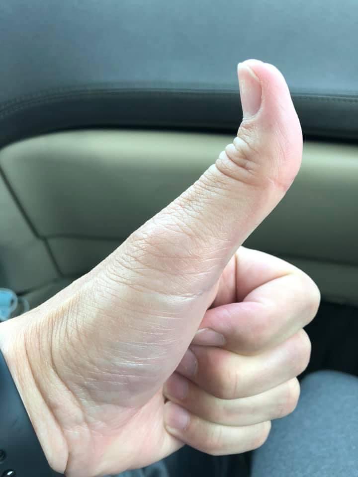 PaulBaileyforTN's tweet photo. On my way to Vanderbilt to have a severed tendon repaired in my right thumb. Apparently a bone spur, on top of my wrist, cut through the tendon.  #onlyonethumbsup #injuredlist #unhandywipes #UpdateLater https://t.co/M8T1WNi5n8