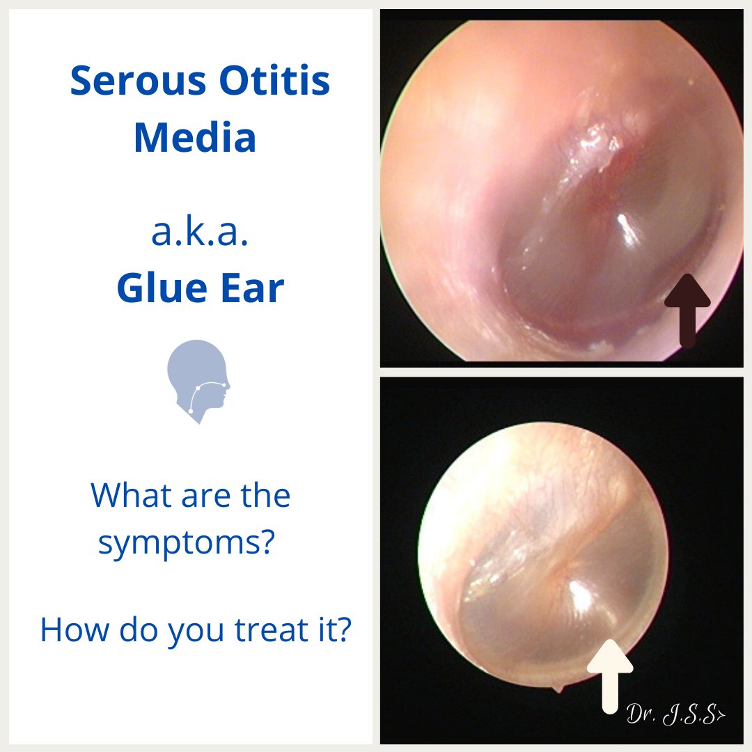 SuraEnt's tweet photo. 🧑‍🔬#treatment involves use of topical and systemic nasal decongestants, use of Valsalva  manoeuvre to ensure adequate aeration of the middle ear. https://t.co/rdKZuWDAAJ