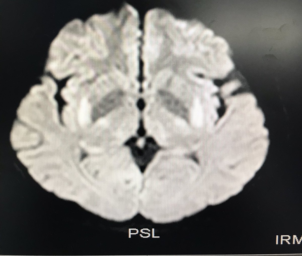 Resonancia Magnética Nuclear en encefalopatía hipóxico isquémica 🧠. #UCI