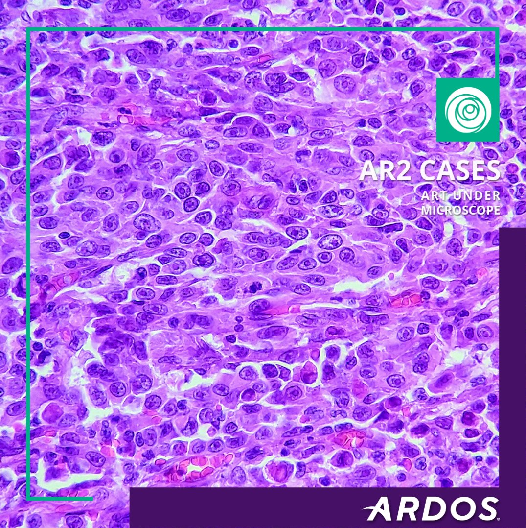ardoslab's tweet photo. ¿Cuántos nucléolos puedes contar en esta población celular neoplásica? ¡Nosotros más de 20!

H&amp;E tinción, 40X objetivo. Copyright © Ardoslab

Descubre la información detallada, aquí ➡️ https://t.co/uM77TCZjbv

#nucleolo #celula #cell #neoplasia #histologia #histology #pathology https://t.co/XXvaqpPjNs