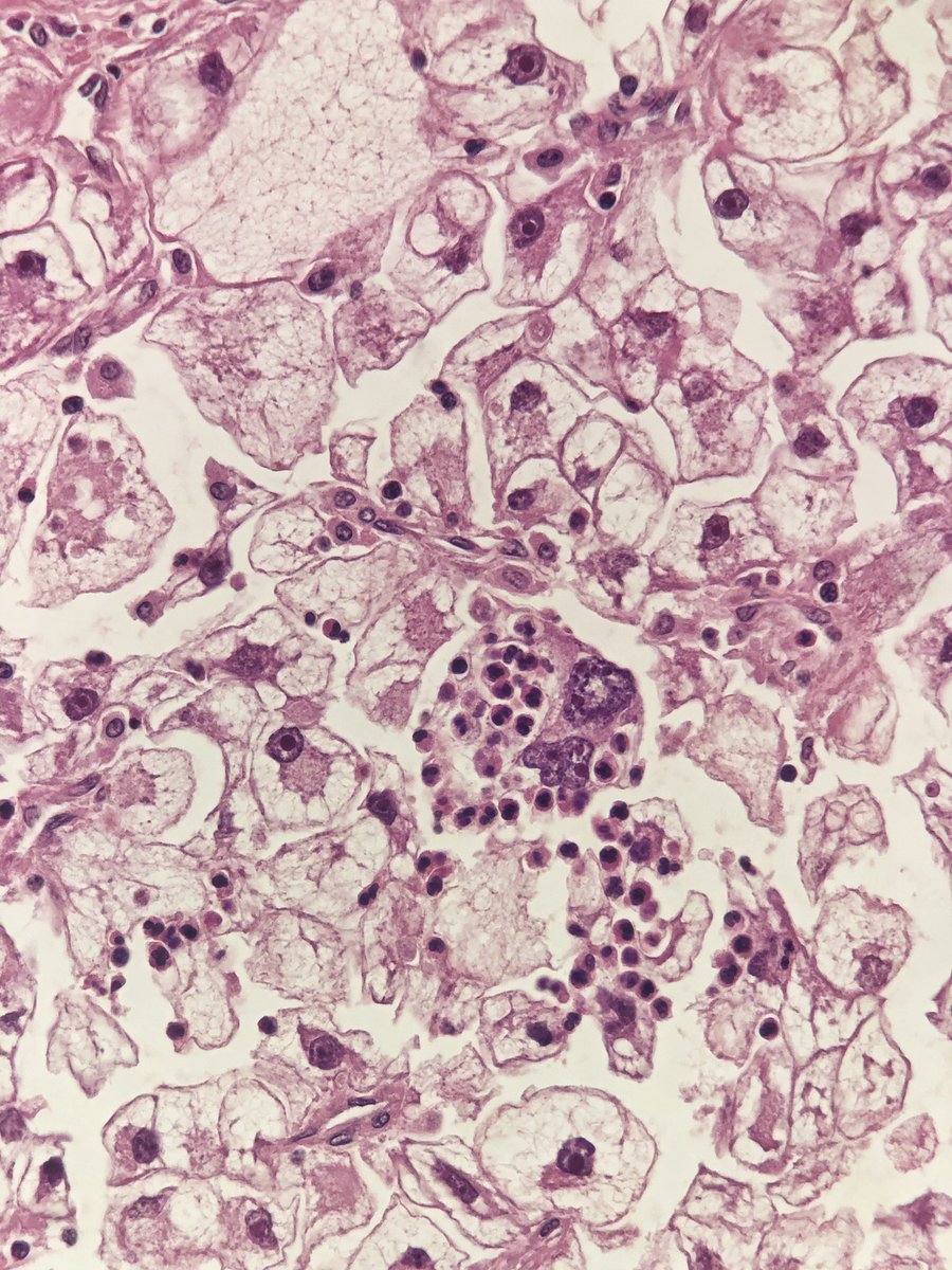 GianniIppolitii's tweet image. We 💜 extensions of fresh renal tumors. Its fun and sometimes is very challenging too! Right @mad_scalpel ?This is a CCRCC with multinucleated giant cells and emperipolesis! Gorgeous!
#UROpath #cytopath #PathTwitter #pathology #pathresidents #cytology #pathologist @bellvitgepath