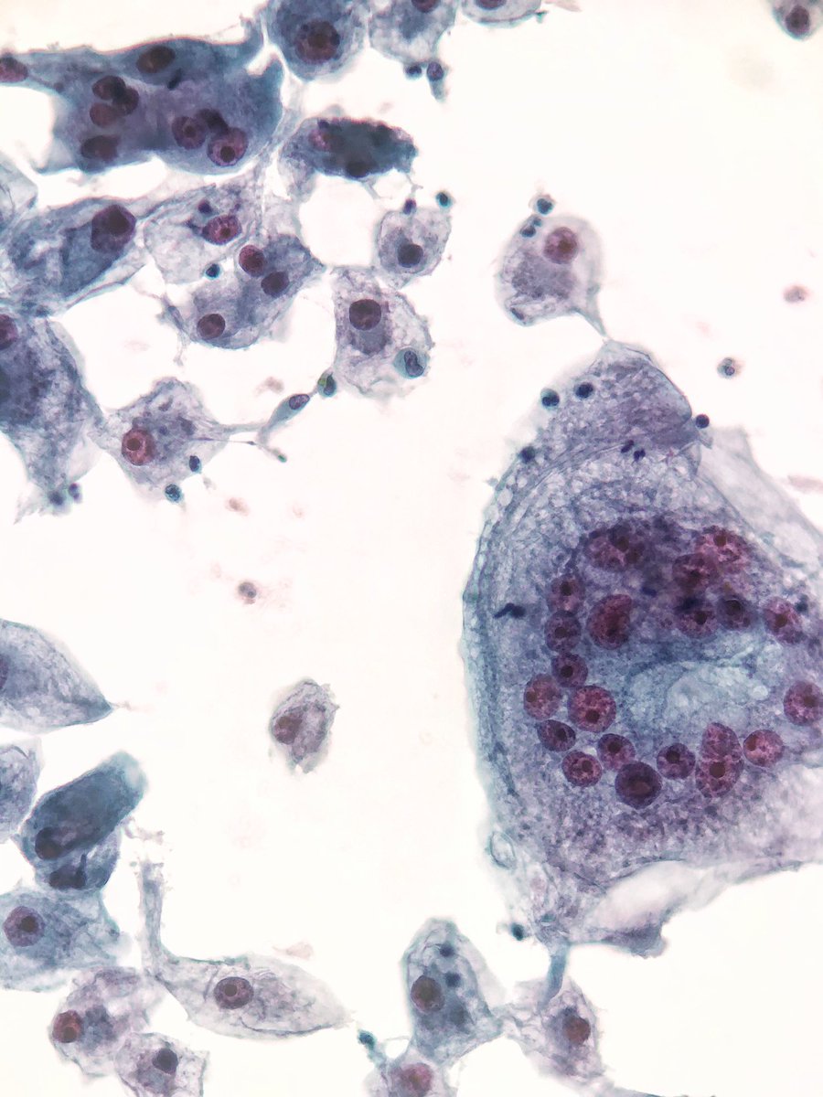 GianniIppolitii's tweet image. We 💜 extensions of fresh renal tumors. Its fun and sometimes is very challenging too! Right @mad_scalpel ?This is a CCRCC with multinucleated giant cells and emperipolesis! Gorgeous!
#UROpath #cytopath #PathTwitter #pathology #pathresidents #cytology #pathologist @bellvitgepath