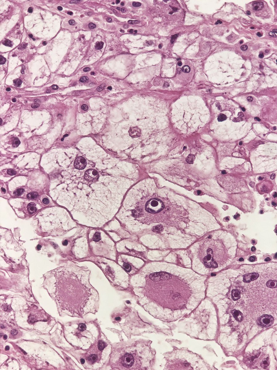 GianniIppolitii's tweet image. We 💜 extensions of fresh renal tumors. Its fun and sometimes is very challenging too! Right @mad_scalpel ?This is a CCRCC with multinucleated giant cells and emperipolesis! Gorgeous!
#UROpath #cytopath #PathTwitter #pathology #pathresidents #cytology #pathologist @bellvitgepath