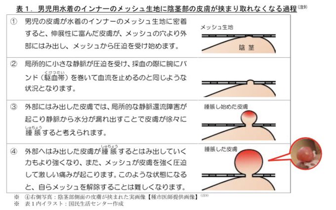 閲覧注意 男児用水着のインナーメッシュでケガの恐れ 症例報告の画像がヤバイ まとめダネ 閲覧注意 男児用水着のインナーメッシュでケガの恐れ 症例報告の画像がヤバイ まとめダネ