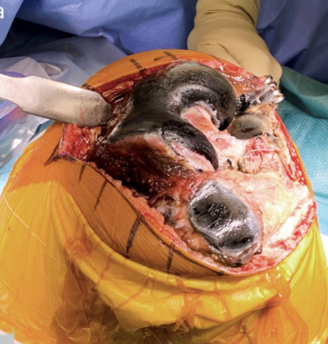 JIMD_Editors's tweet image. A 53-year-old man was referred to the orthopedic clinic for a knee replacement surgery. The patient c/o pain in several joints from 30, mostly affecting lumbar spine. The surgeon was startled to observe a striking discoloration of the cartilage. doi.org/10.1002/jimd.1…