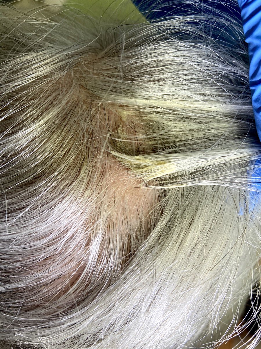 AndamoyoAlberto's tweet photo. Acude una paciente con picor localizado en el cuero cabelludo de meses de evolución. Se aprecian pelos envueltos por placas con cierto parecido al amianto. Nos encontramos ante una “falsa tiña amiantácea”.
#scalp #dermatology #dermatitis #ConsultaPopular https://t.co/RyXeesdicd
