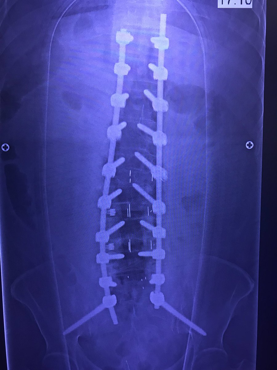 jasonpycheung's tweet image. Good lordotic improvements