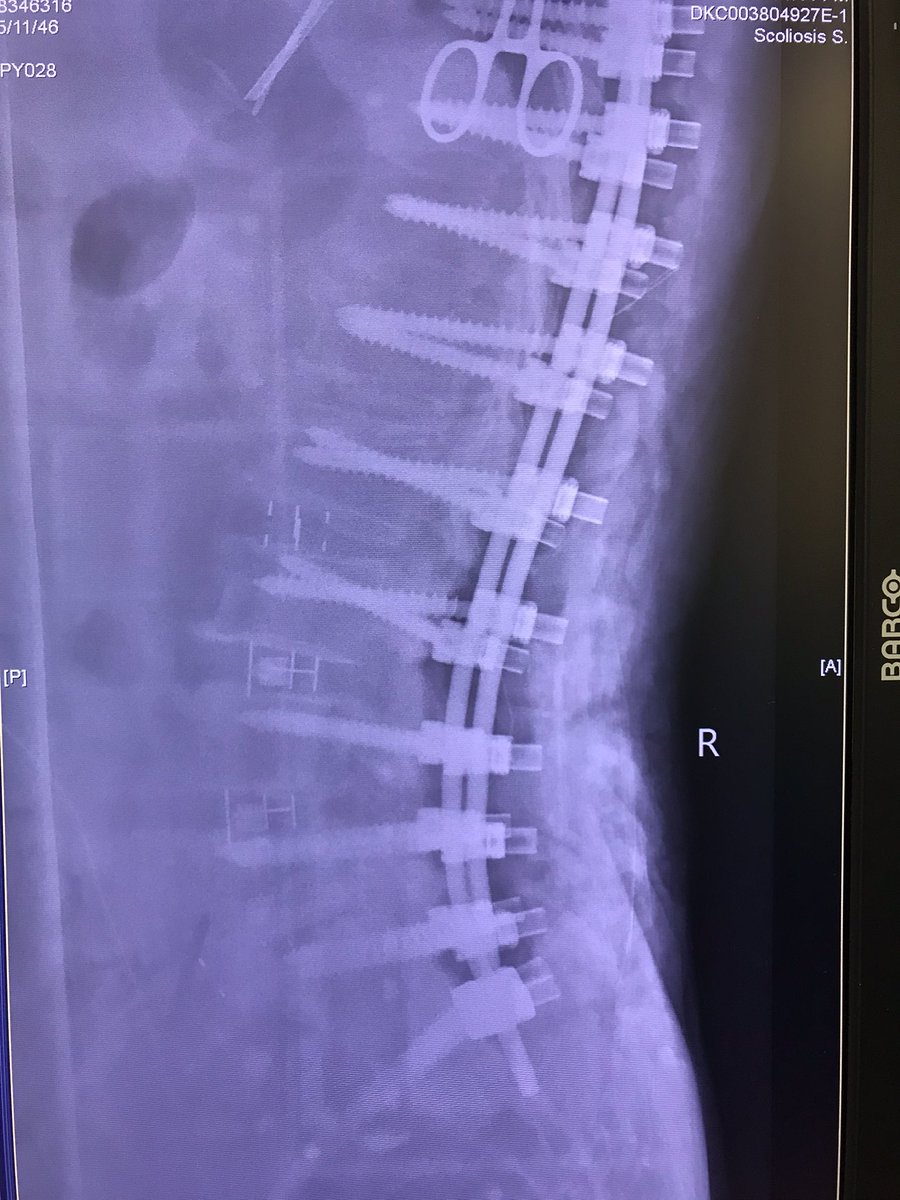 jasonpycheung's tweet image. Good lordotic improvements