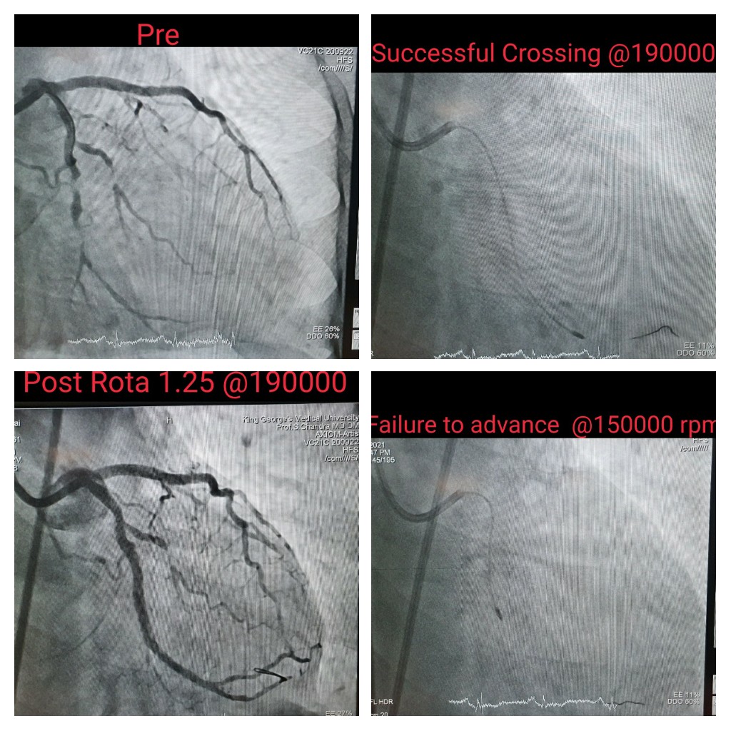 DrAshishCardio's tweet image. LCx Rotablation is always challanging. Successful LCx Rotablation in 50 Male, class III angina with previous failed attempted PCI. 1.25 Burr at high speed did the trick. excellent result.
#CardioTwitter
#rotablation 
#KGMU