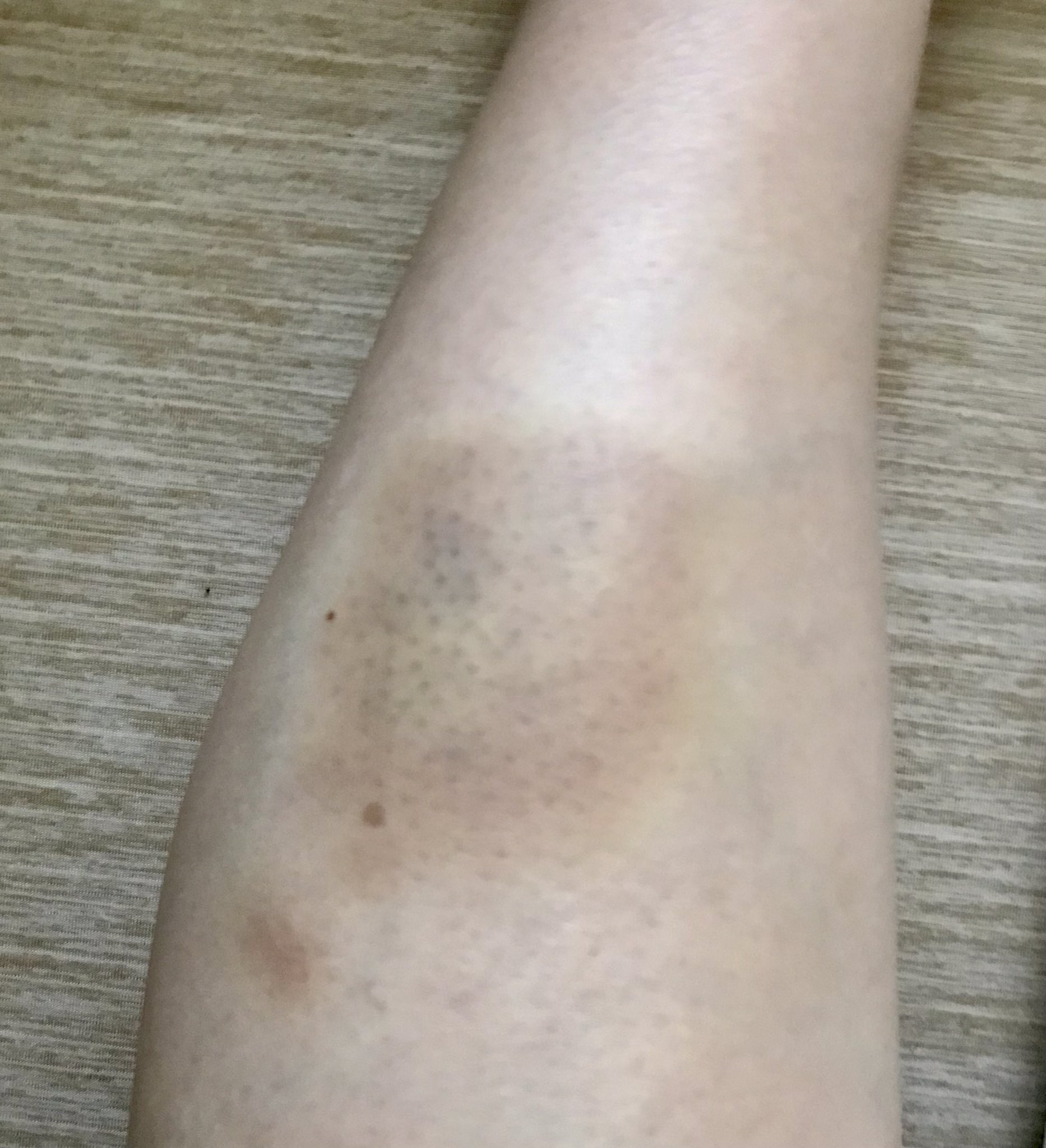 いろは A Twitter 身に覚えのないアザが進化してます 痛々しい です 痛くて正座は無理 この痛み みんな分かるよね 弱気 打ちみ 青あざ T Co Nlpegkdsgv Twitter