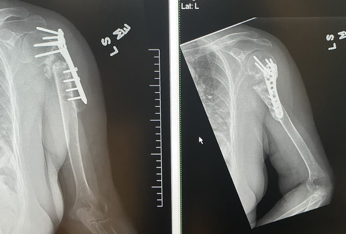 JanetConwayy's tweet image. 8 months post Left proximal humeral nonunion repair with revision ORIF and RIA reamer. That humeral head was definitely worth saving! 👍🤗#orthotwitter #Limblengthening #OTA #nonunion