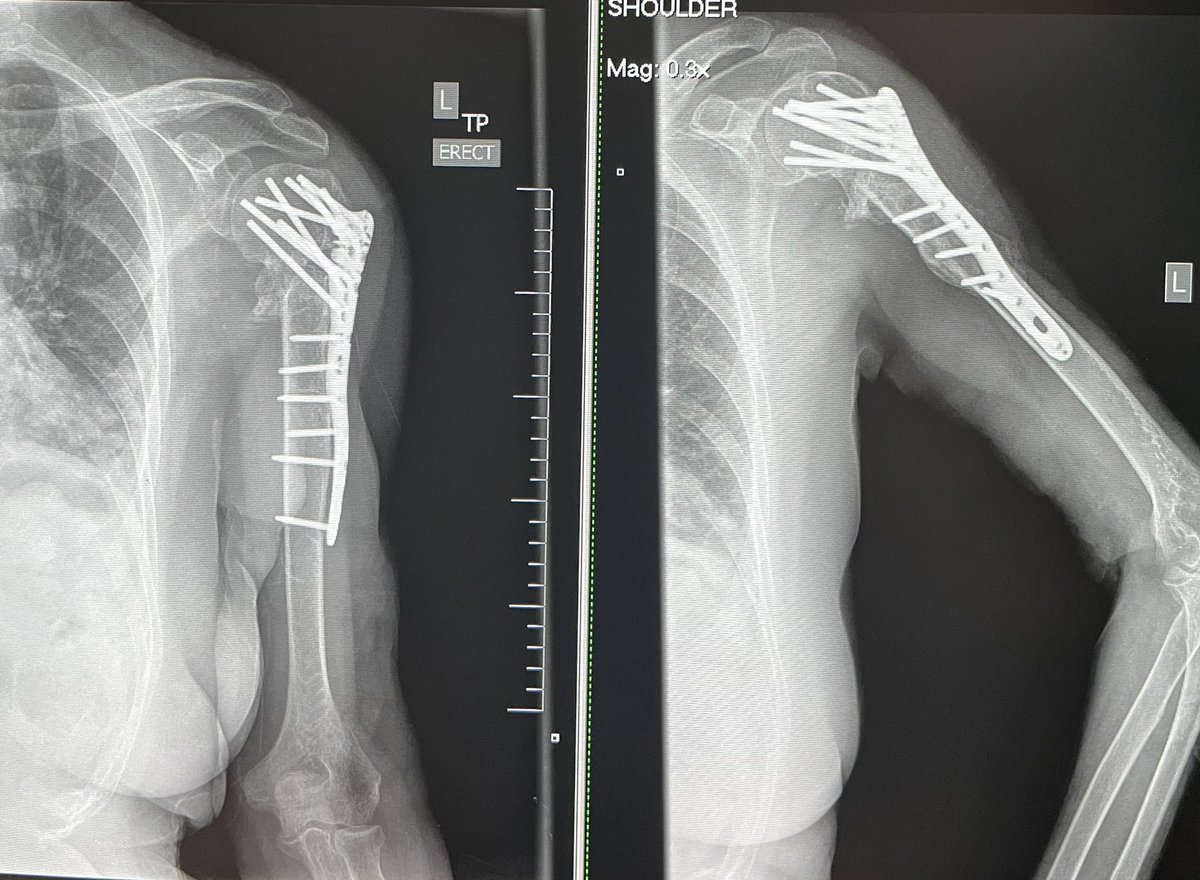 JanetConwayy's tweet image. 8 months post Left proximal humeral nonunion repair with revision ORIF and RIA reamer. That humeral head was definitely worth saving! 👍🤗#orthotwitter #Limblengthening #OTA #nonunion