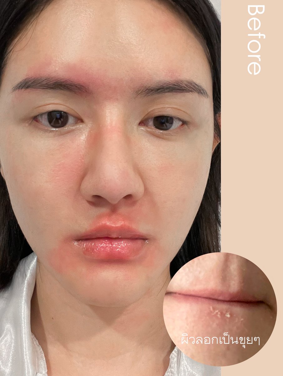 xoxoxomxoxo's tweet image. ใครมีปัญหา #Sebderm แนะนำครีมนี้! เราเป็นมานาน เรื้อรังมาก ไปหาหมอจ่ายแต่สเตียรอยด์ไม่ไหว 😭 ตัวนี้ดีมากไม่มีสเตียรอยด์ เป็น Ectoin 7% ไม่เป็นเซ็บเดิร์มก็ใช้ได้ แพ้ง่ายก็เหมาะ ดีมากไปลอง #ไว้รีวิวห้ามขายของโว้ยย #ใช้ดีบอกต่อ 
Resiskin by Qualisk พิกัด shp.ee/smstgnu