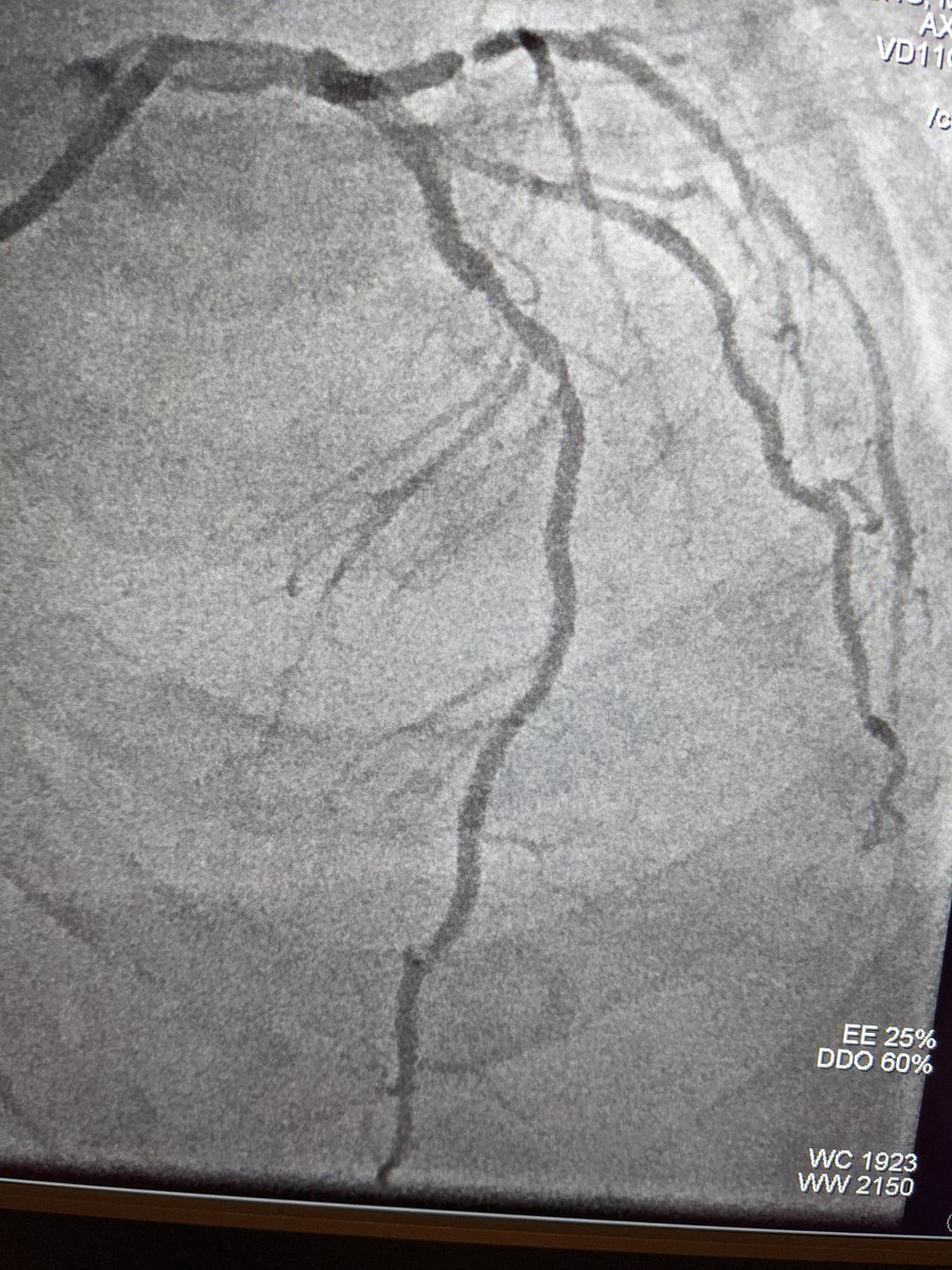 MatthewChungMD's tweet photo. 82 yo
CKD IV
Obese
Cr 2.74
eGFR 20
3V CAD
DM2
EF 45%
Turned down for CABG 2/2 frailty & risk of ESRD with a pump run
#IVUS guided PCI of LAD (1 stent) & LCx (2 stents)
Calculated maximum allowable dye 47 mL
LAD 21 mL
LCx 17 mL
Total 38 mL
Stage RCA
Love @Philips #SyncVision https://t.co/BoZvxAAbbS