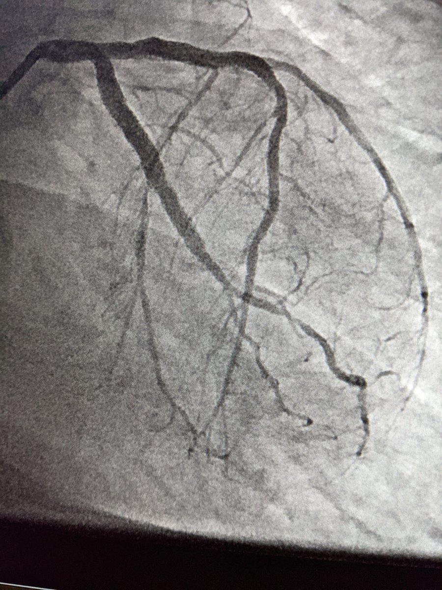MatthewChungMD's tweet photo. 82 yo
CKD IV
Obese
Cr 2.74
eGFR 20
3V CAD
DM2
EF 45%
Turned down for CABG 2/2 frailty & risk of ESRD with a pump run
#IVUS guided PCI of LAD (1 stent) & LCx (2 stents)
Calculated maximum allowable dye 47 mL
LAD 21 mL
LCx 17 mL
Total 38 mL
Stage RCA
Love @Philips #SyncVision https://t.co/BoZvxAAbbS
