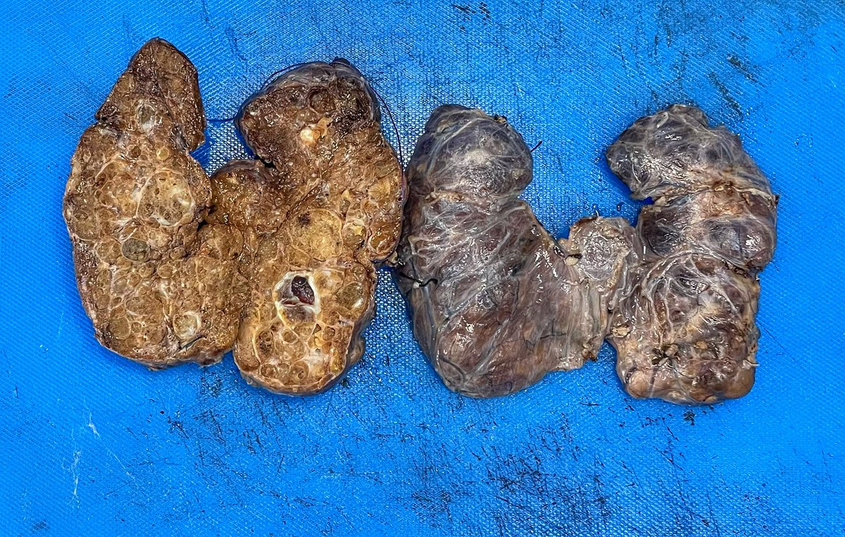 NidhinMd's tweet image. Multinodular goitre.  #PathTwitter #twitterpath #pathresident #pathboards #histopath