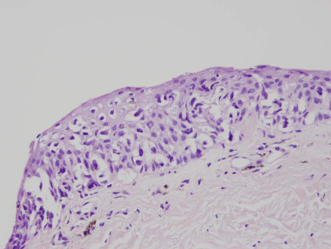 Paciente mujer de 72a . Melanoma subungueal .Atentos  a las Melanoniquias longitudinales