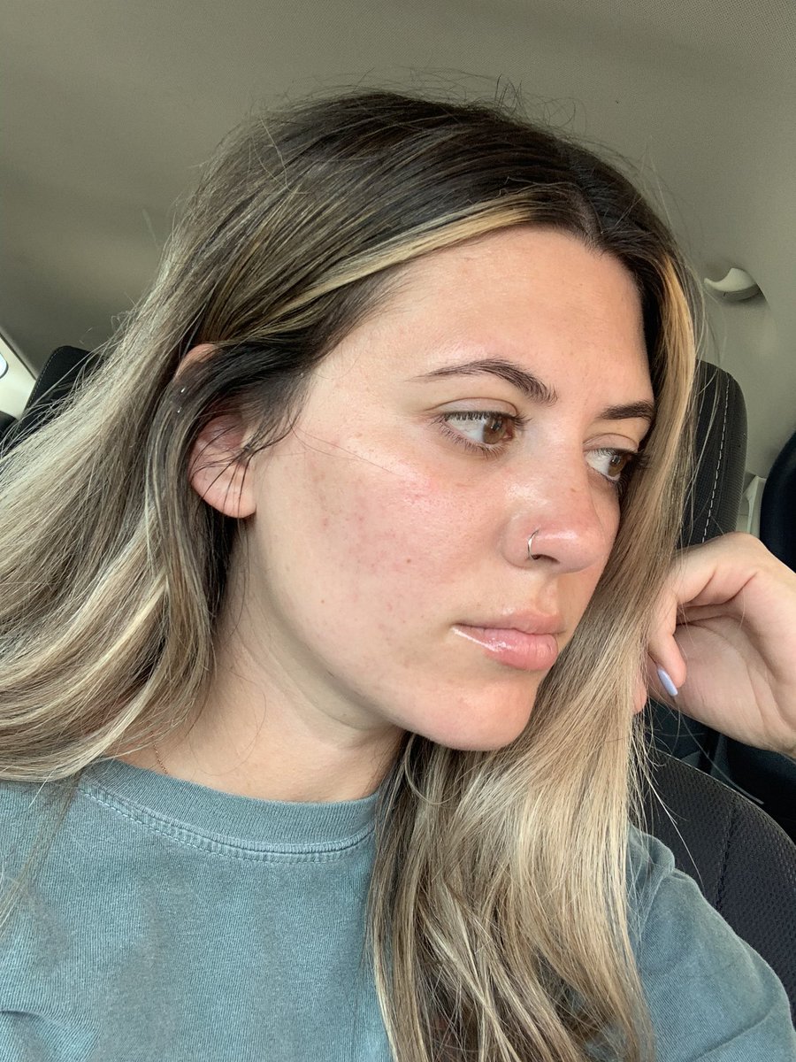 _errrinnn's tweet photo. The first pics are so hard for me to post, but I’m finally happy with where my skin is so here’s a transformation for y’all! Beginning of 2018 when I was at the lowest point in my life vs today. It’s crazy how much a little self care and a bunch of happiness can affect ❤️ https://t.co/23s0zIC19b