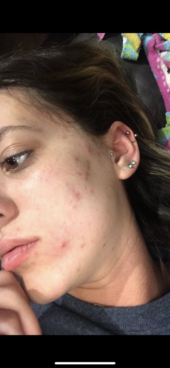 _errrinnn's tweet photo. The first pics are so hard for me to post, but I’m finally happy with where my skin is so here’s a transformation for y’all! Beginning of 2018 when I was at the lowest point in my life vs today. It’s crazy how much a little self care and a bunch of happiness can affect ❤️ https://t.co/23s0zIC19b