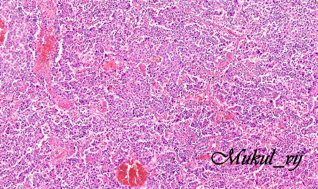 vij_mukul's tweet photo. A perfect Lymphoepithelioma-like hepatocellular carcinoma (LEL-HCC).
Rare variant
Overall lower recurrence, overall favorable survival rate
Not associated with EBV 
High level of PD-L1 and PD1 in intratumoral inflammatory cells 
https://t.co/iYr1hfFYOa
#liverpath #pathtwitter https://t.co/XxhB7AouXg