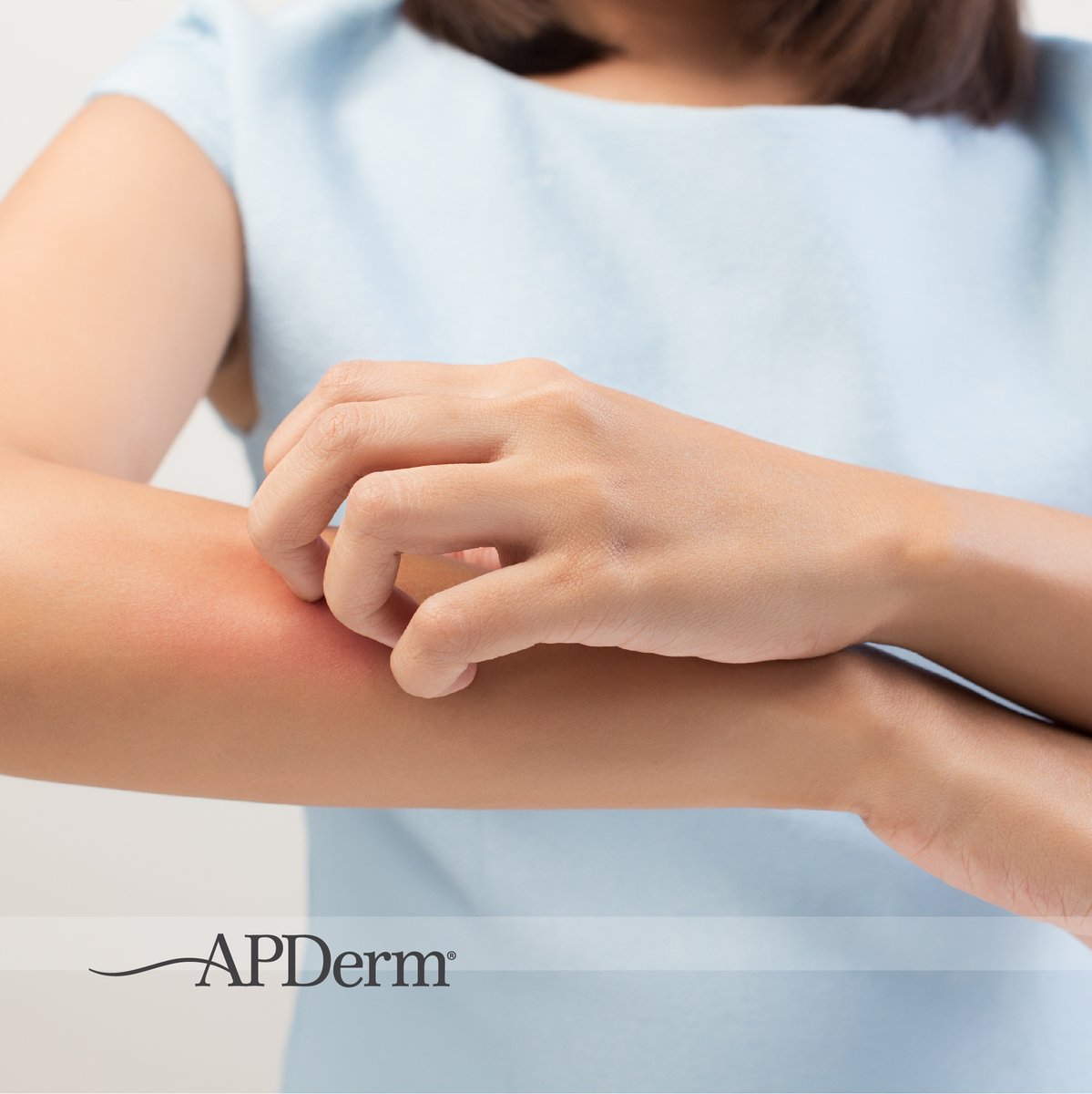 ap_derm's tweet image. #Summer is full of fun things to do outdoors, but sometimes the camping and beach trips can lead to bumps and spots! Learn tips for the most common summer #rashes and #bugbites in our latest blog post. 
bit.ly/3xZQfqn