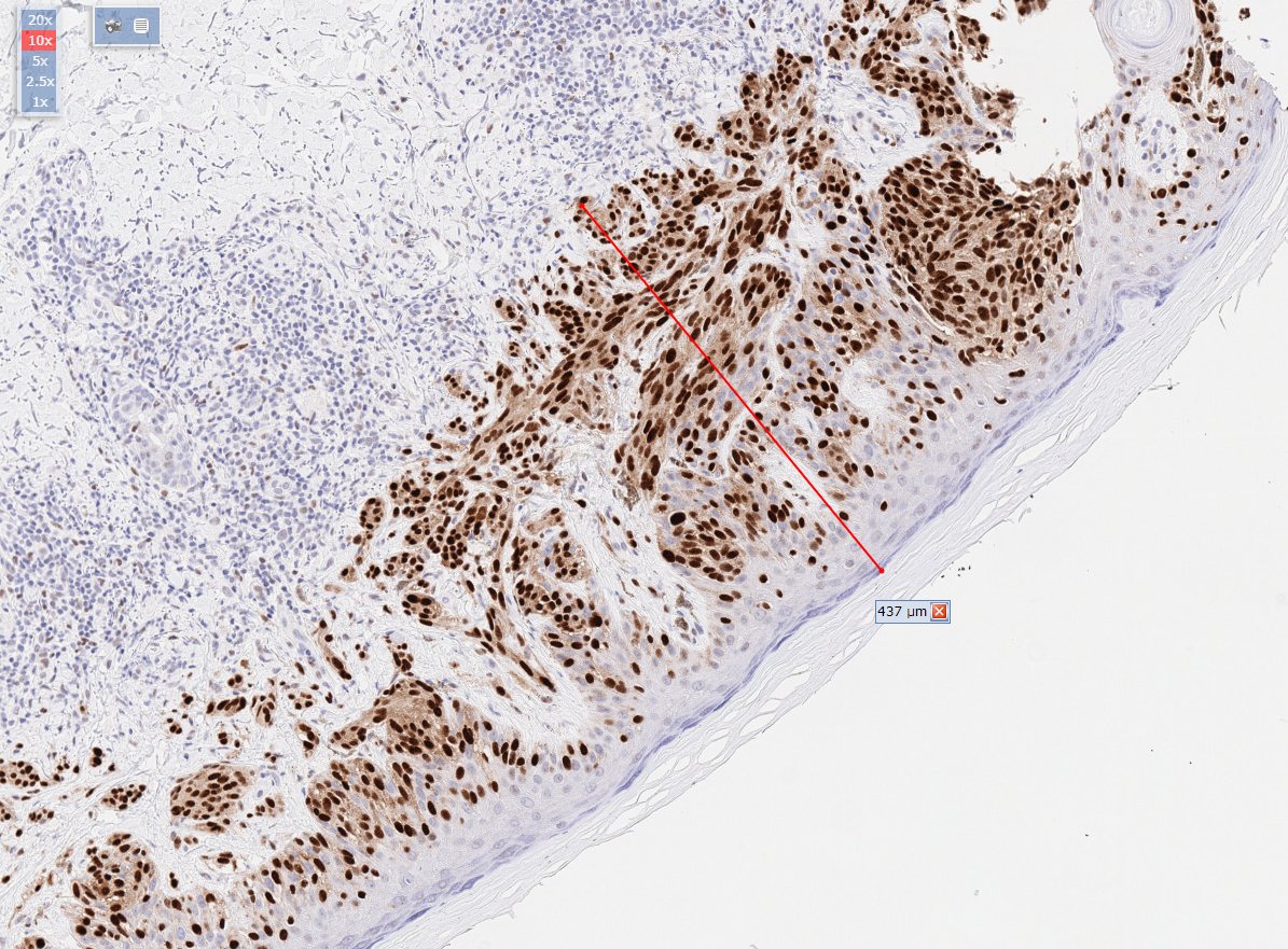 HENRYY_MD's tweet photo. Neogenomics #PRAME stain is pretty and very good!
#dermpath  @et565 @tonitatirado  Hope all yours are as good as this https://t.co/gKGwyQ9bQa