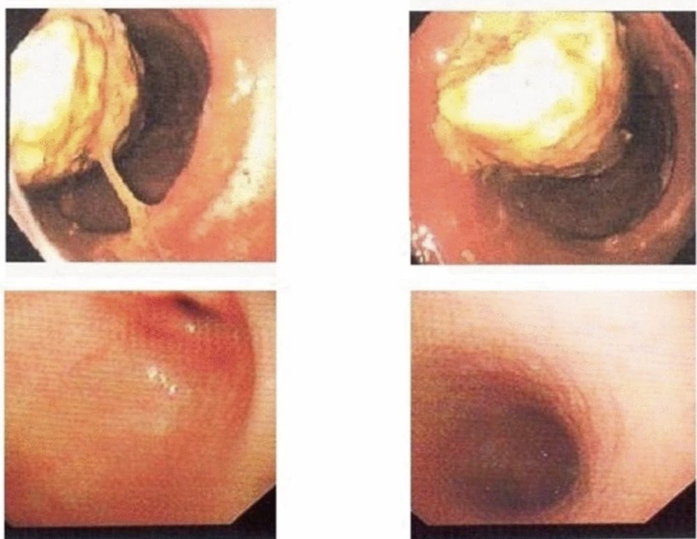 10bladeae's tweet photo. It’s your favorite time of the week &amp;
We have an all new #FIOF up on https://t.co/sCaHvyqLtR! This patient comes to you post LSG with nausea, vomiting and early satiety. There’s an extra #HINT in the scenario to help reach the dx!  
#10blade
#SoMe4Surgery #SurgicalResident #UAE https://t.co/3LFC5DCJRx