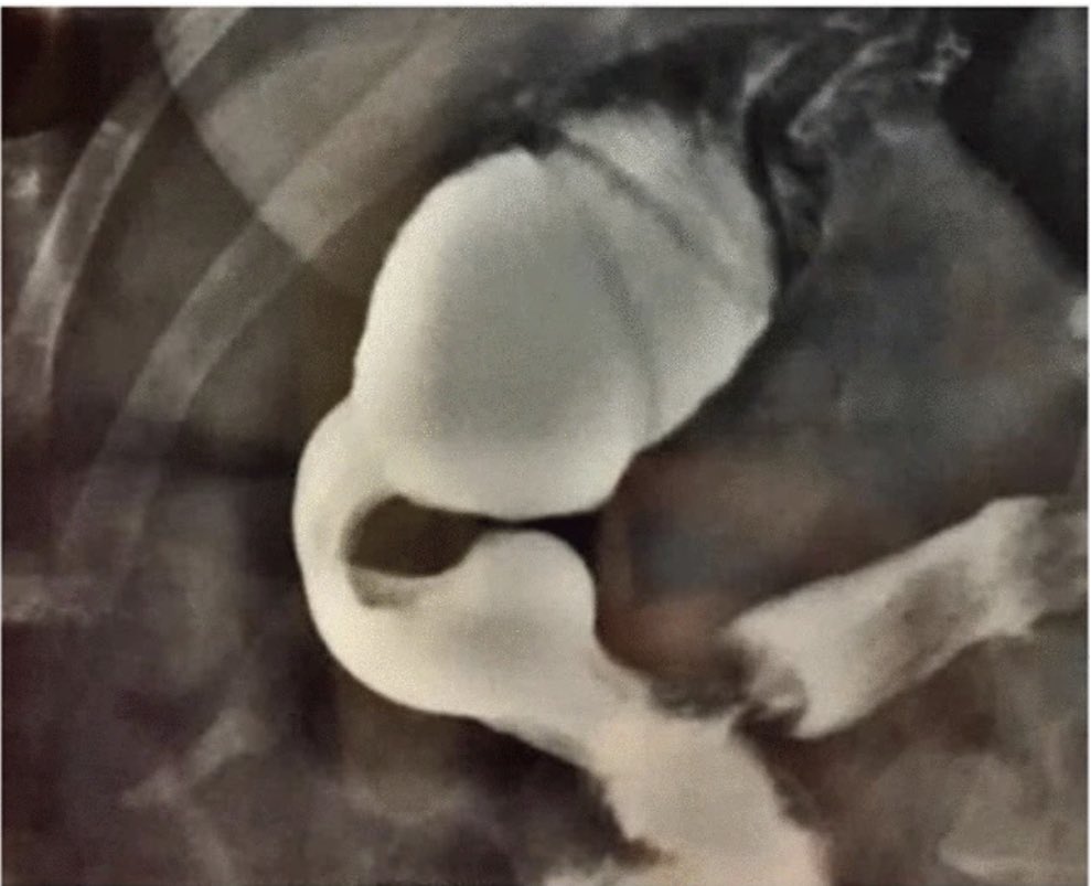 10bladeae's tweet photo. It’s your favorite time of the week &amp;
We have an all new #FIOF up on https://t.co/sCaHvyqLtR! This patient comes to you post LSG with nausea, vomiting and early satiety. There’s an extra #HINT in the scenario to help reach the dx!  
#10blade
#SoMe4Surgery #SurgicalResident #UAE https://t.co/3LFC5DCJRx