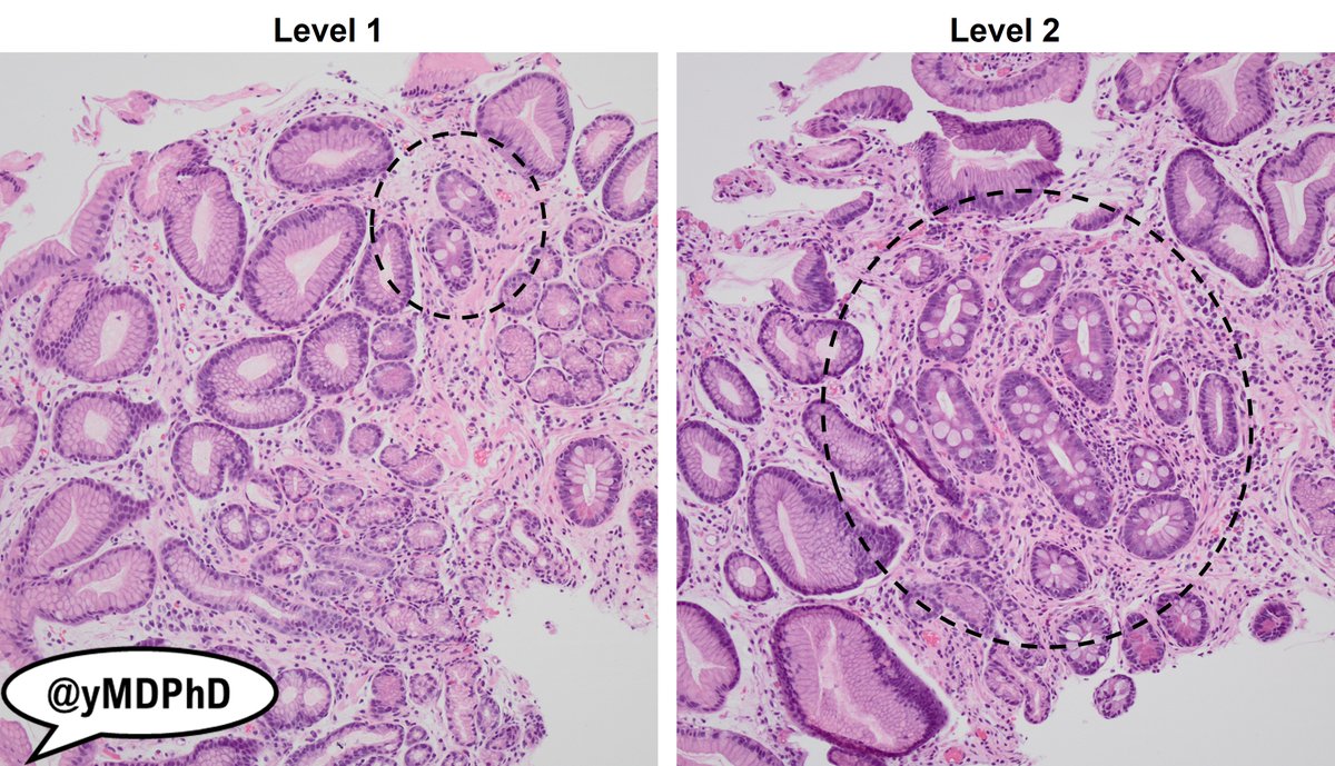 yMDPhD's tweet photo. Examining multiple levels on a seemingly endless tray of GI biopsies can be tiring, but can sometimes pay off immensely.
Look at how much more intestinal metaplasia is on level 2 than level 1 of this stomach biopsy.
No surprise, it's almost gone again on level 3.
#yPathPearls https://t.co/L4ttnzWs51