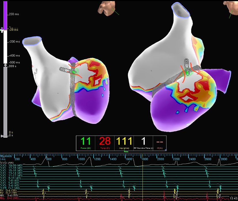 XavierR_EP's tweet photo. Fridayβs are still for #OpenWindowMapping w/ #HDGrid
Dr. Rhee eliminated this 3x WPW redo at the 11 oβclock position on the TV after 1 second of RF w/ #TactiCathSE
Healthy kiddo; Happy Weekend π https://t.co/fxJFOIvY4V