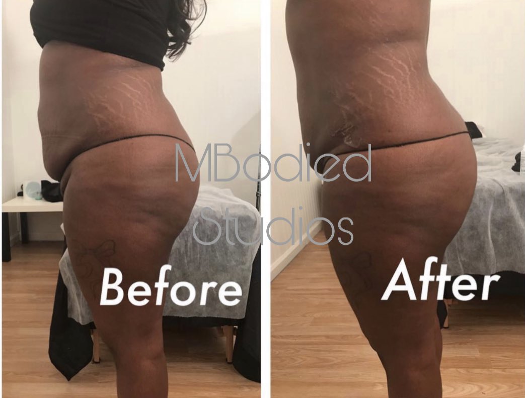 kaliworldd's tweet photo. Hii🤗 so I just recently started my Body Contouring business. I offer Laser Lipo, Vacuum therapy, RF skin tightening and more. I’m located in Atlanta. 

I'd really appreciate it if you guys retweet for exposure &amp; follow me on Instagram🥺 @MBodiedStudios Thank u in advance!💖💖 https://t.co/psnVdvs4Nd
