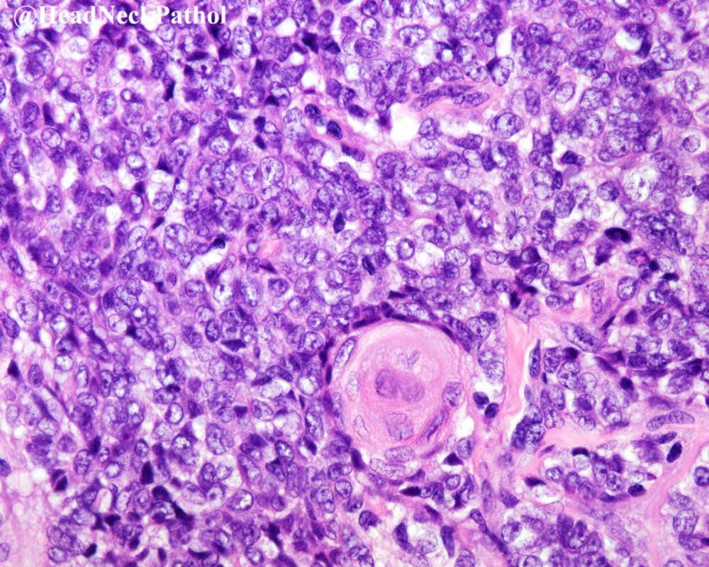 HeadNeckPathol's tweet photo. Mesenchymal Neoplasms of Salivary Glands: A Clinicopathologic Study of 68 Cases
Authors: Jaylou M. Velez Torres, Ernesto Martinez Duarte, Julio A. Diaz-Perez, et al.    
https://t.co/kaOBtt4tXK
#HeadNeckPathol #HNPJ #HeadandNeckPath #Pathology #ENTPath #PathologyTweet https://t.co/hoHAM1srmj
