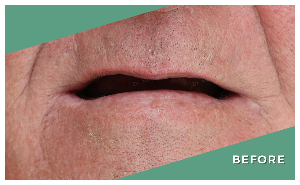 drmotiwaladcic's tweet image. Peace begins with a SMILE!

Full mouth dental implants with NexxZr Zirconia bridge 

#permanentteethin3days #immediateloadingimplants #singlepieceimplant #pterygoidimplant #basalimplants #singlevisit #nexxzrzirconiacrowns
#fullmouthdentalimplants #dentalimplants